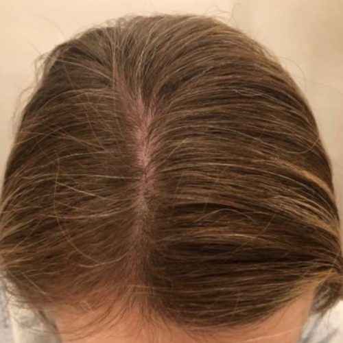 PRP for hair loss female after