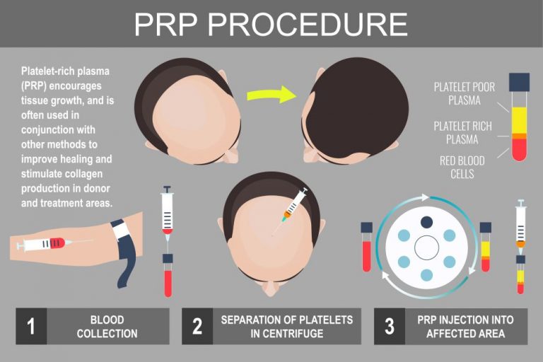 PRP for hair loss