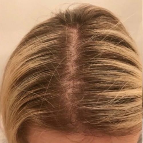 PRP for hair loss female before