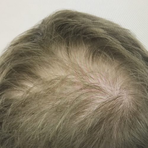 PRP for hair loss male before