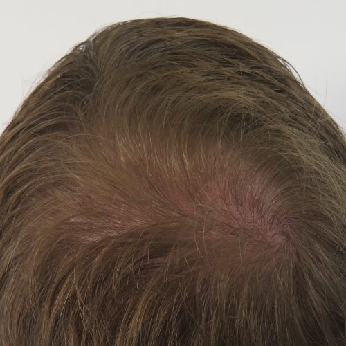 PRP for hair loss male after