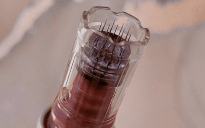 Why micro needling is the ultimate natural aesthetic treatment