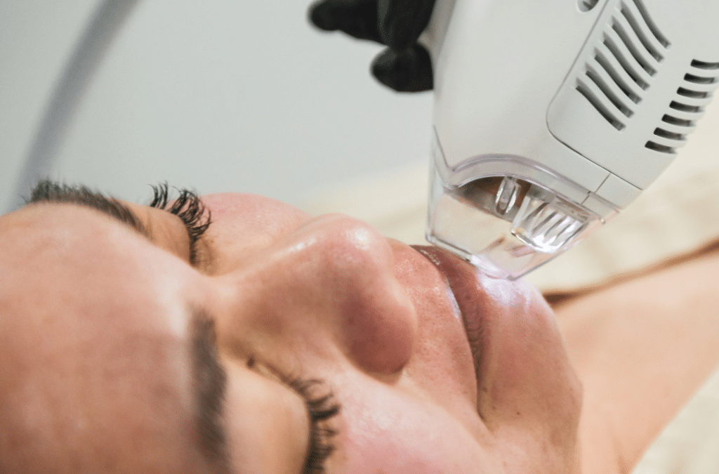 The Ultimate Guide to Treating Acne Scarring with Tixel