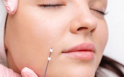 PDO Thread Lift:The Ultimate Rejuvenation