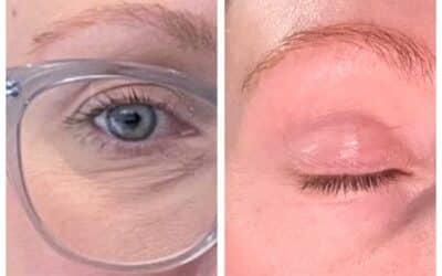 Tighten, Brighten, Transform: The Ultimate Dark Circles Treatment