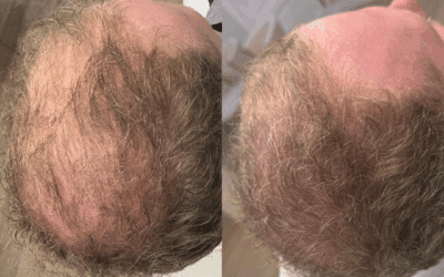 PRP Hair Loss Treatment Belfast | Dr Janice Brown Aesthetics & Skin