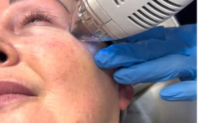 Tixel Skin Treatment Belfast by Dr Janice: A Non-Invasive Way to Rejuvenate Skin