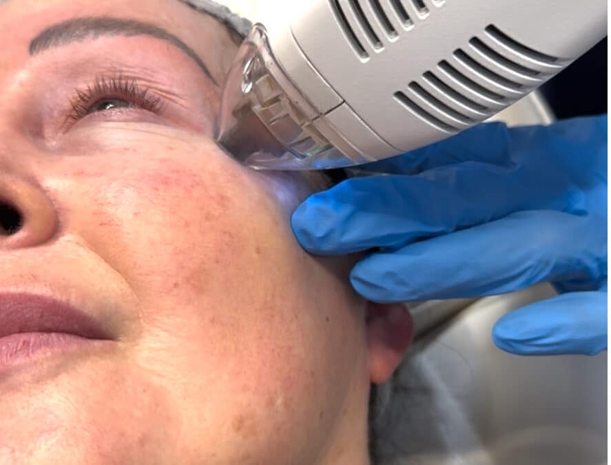 Tixel Skin Treatment Belfast by Dr Janice: A Non-Invasive Way to Rejuvenate Skin