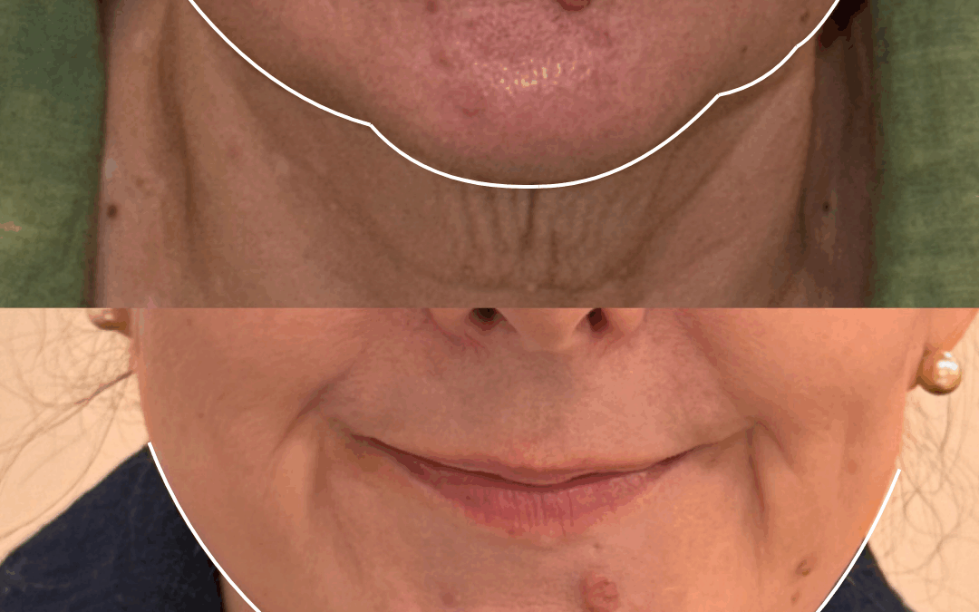 Anti-wrinkle Injections for Jowls, Platysmal Bands, and Neck Tightening
