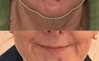 Anti-wrinkle Injections for Jowls, Platysmal Bands, and Neck Tightening