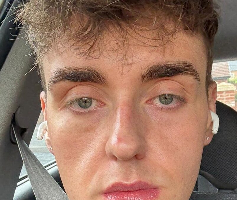 The Truth About Ozempic Face: Restoring Confidence After Rapid Weight Loss in Belfast