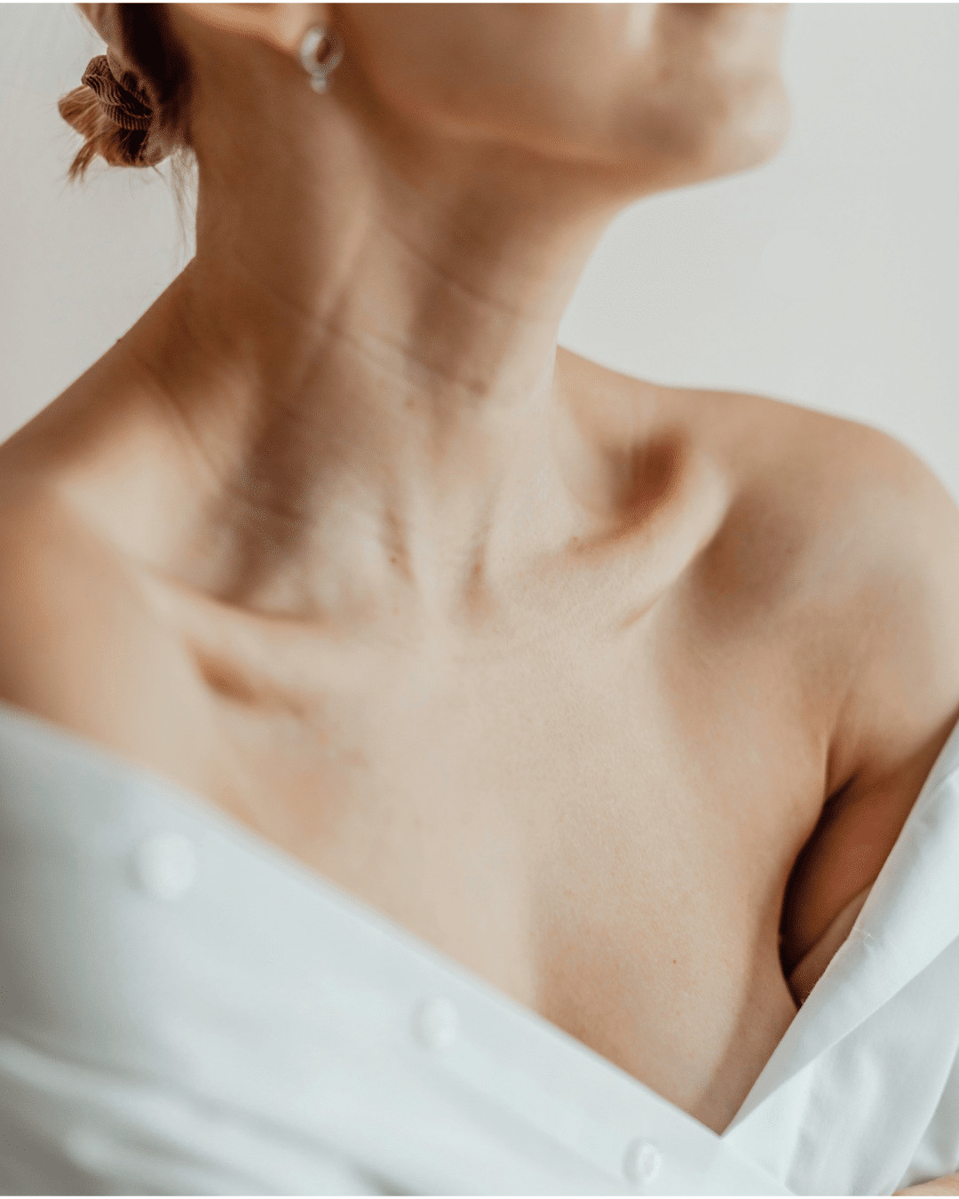Improvement in neck and chest skin quality following Sculptra collagen stimulation treatment